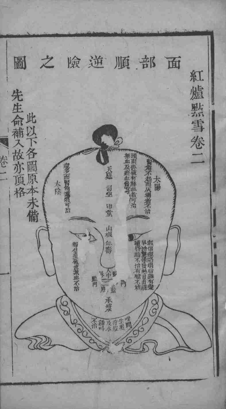 痘科红炉点雪  卷2